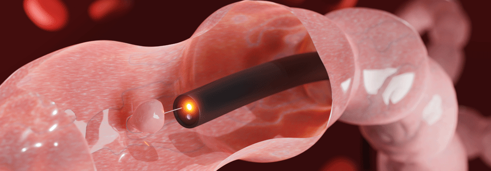 Im Gegensatz zum FIT ermöglicht eine Koloskopie gleichzeitig die minimalinvasive Resektion von Tumorvorstufen.