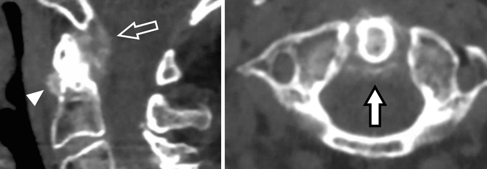 Die sagittale CT der Halswirbelsäule (links) ergab Verkalkungen entlang der periodontalen Ligamente und im Bereich des vorderen atlantoaxialen Ligaments. Das axiale Bild (rechts) zeigt beispielhaft die Kalzifizierungen entlang des Lig. transversum atlantis.