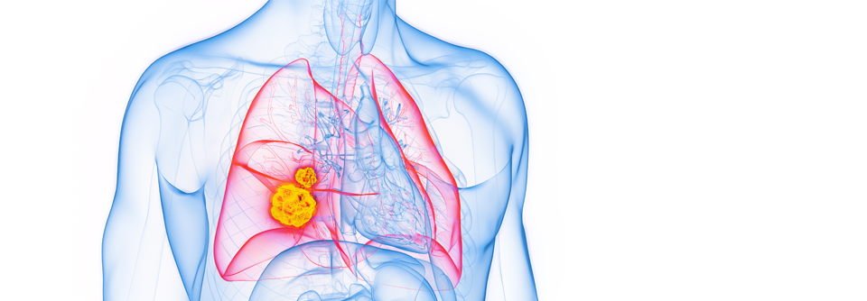 Durvalumab könnte eine neue Behandlungsoption für Patienten mit resektablen NSCLC darstellen.