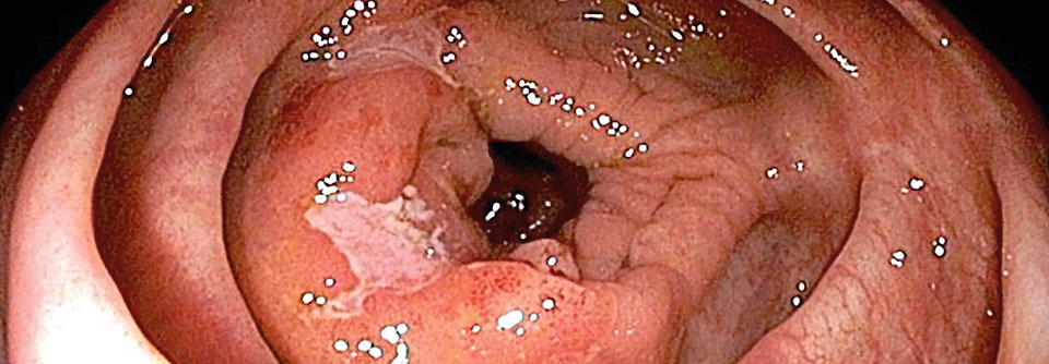 Bei aktivem Morbus Crohn kommt es zu Ulzera und Entzündungen in der Schleimhaut von Dick- und Dünndarm.