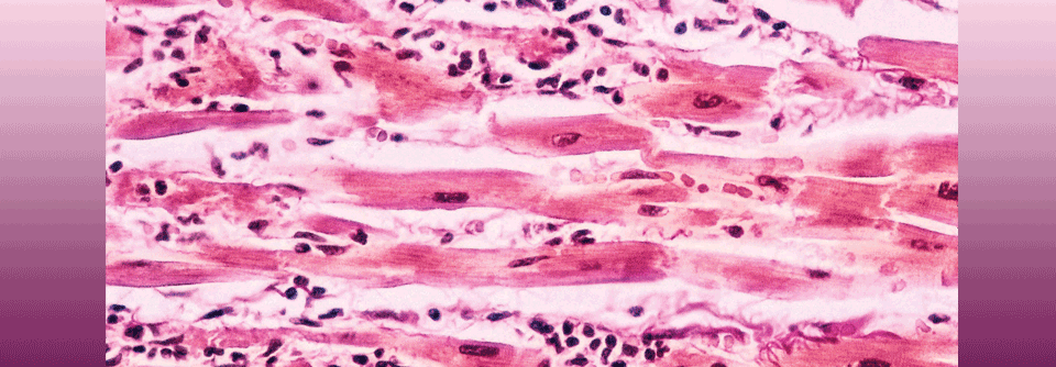 Das histologische Bild einer Myokarditis ist gekennzeichnet durch Entzündungszellen zwischen den Muskelsträngen.