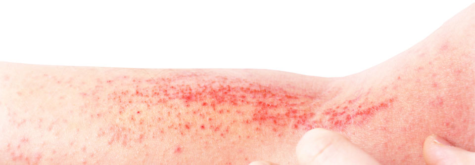 Die Ausprägung einer Radiodermatitis wird offenbar durch ein Zusammenspiel aus Hautmikrobiom und individuellen Risikofaktoren, wie dem Immunstatus, bestimmt.