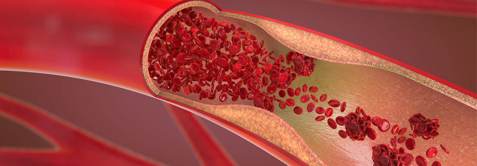 Die Optimierung von Risikofaktoren (z.B. Blutdruck-, Cholesterin- und Diabeteseinstellung)
wird empfohlen.