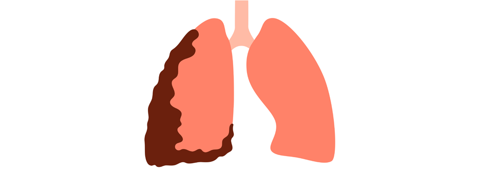 Gemäß Prof. Tsao kann ein operatives Debulking die Kompression der Lunge verringern und so die Atmung verbessern.