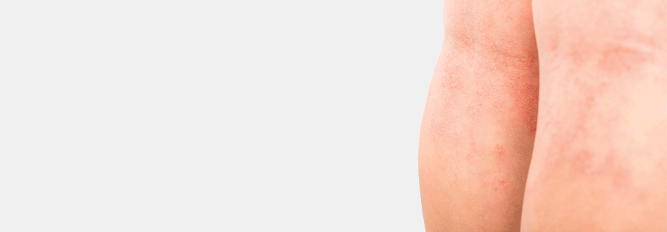 Die Kniekehlen sind ein typischer Manifestationsort bei der atopischen Dermatitis.