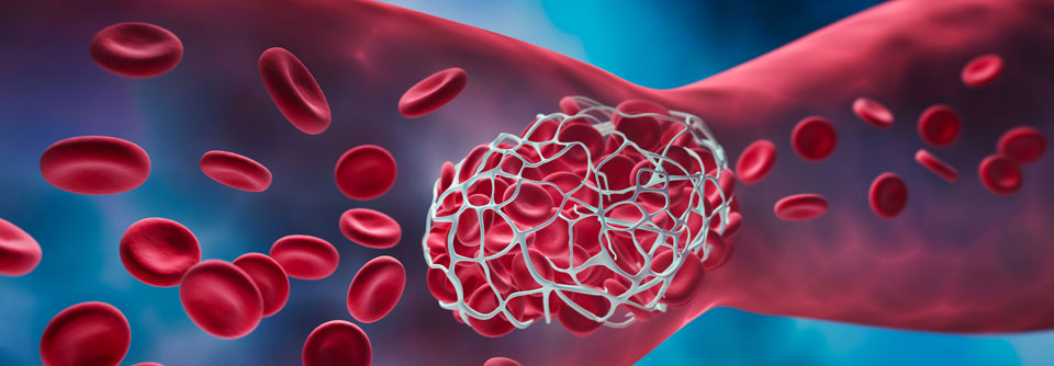 Eine gefährliche Form der thrombotischen Mikroangiopathie ist die thrombotisch-thrombozytopenische Purpura, kurz TTP.