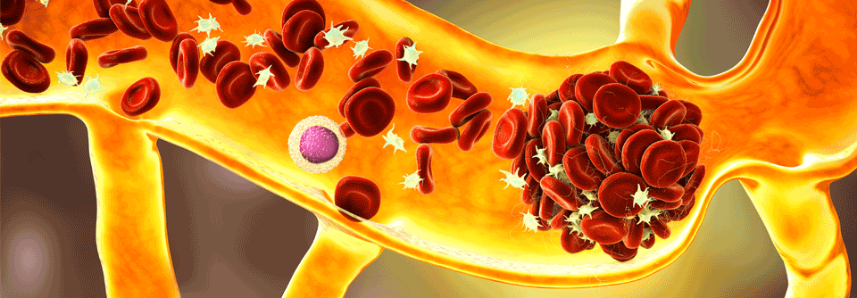 Behandelt wird das Antiphospholipidsyndrom oder der aPL-AK-Trägerstatus mittels Antikoagulation.