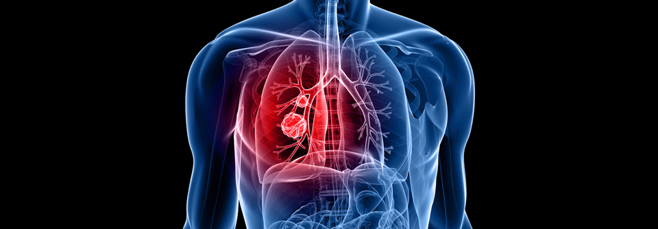 Die FINN-Studie bestätigt, dass NSCLC Patient:innen auch bei geringer PD-L1-Expression von Kombinationen profitieren.