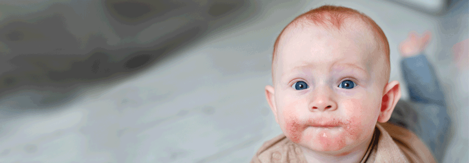 Neurodermitis: Frühe und intensive Therapie verspricht Schutz vor Hühnereiweißallergie Tatsächlich traten in der intensiv behandelten Gruppe nach 28 Wochen signifikant weniger Hühnereiweißallergien auf (31,4 % vs. 41,9 %). (Agenturfoto)