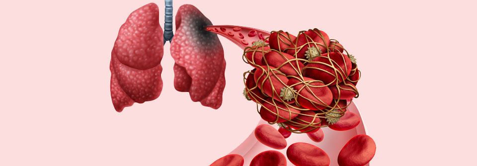 Steckt im Truncus pulmonalis ein Gerinnsel fest, sind die Überlebensaussichten schlecht.