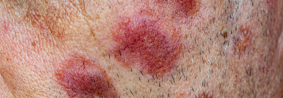 mTOR-Inhibition könnte bei kutaner Sarkoidose effektiv sein Eine systemische Behandlung der kutanen Sarkoidose erzielte in einer präklinischen Studie vielversprechende Ergebnisse.