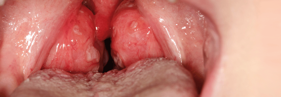 Für diese deutlich geschwollenen Tonsillen eines Zehnjährigen liegt ein positiver Streptokokkennachweis vor.