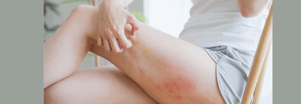 Epidermouflage: Ein Chamäleon kommt aus der Dermatologie Die Laboranalyse deutete auf Inflammation hin: Nieren- und Leberwerte normal, keine atypischen Lymphozyten.