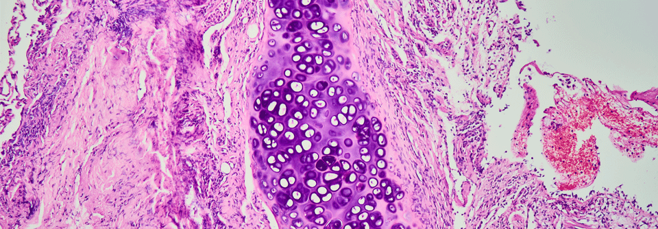 Transbronchiale Lungenbiopsie bei einer kryptogen organisierenden Pneumonie 