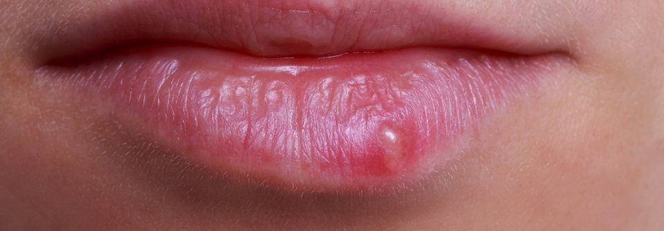 Aciclovir gegen Herpes: Wie lange darf man therapieren? Die kontinuierliche Aciclovir-Suppressionsbehandlung ist die Therapie der Wahl bei rascher Rezidivfolge.