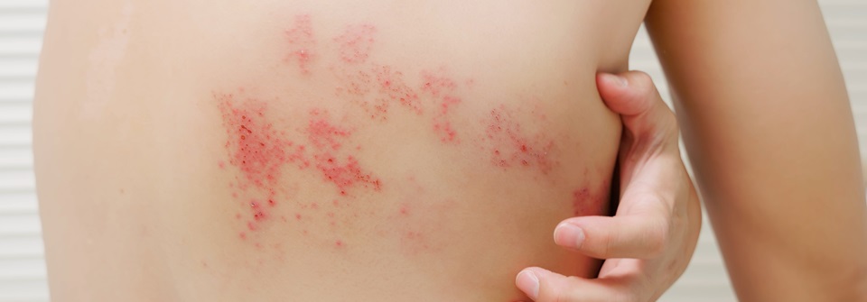Herpes zoster bei Schwangerer: Aciclovir wie üblich verordnen? Kann Aciclovir auch in der Schwangerschaft angewendet werden?