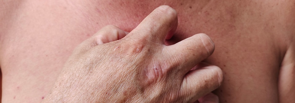 Typ-1- und Typ-2-Diabetes : Hoher Zucker – kranke Haut Patienten mit Diabetes leiden besonders häufig unter Hauttrockenheit.