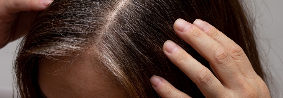 Haarausfall bei Frauen: Ursachen und Behandlung Bei der Frau kommt es mehrheitlich im dritten Lebensjahrzehnt, gelegentlich auch erst im Klimakterium, zur Ausdünnung der Haare im Scheitelbereich.
