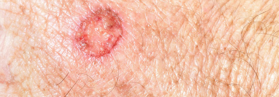 Hauterkrankungen: Dermatologie in der Hausarztpraxis Durch eine schnelle, kostengünstige und leitliniengerechte fachärztliche Diagnostik kann Hautkrebs schneller erkannt und behandelt werden.