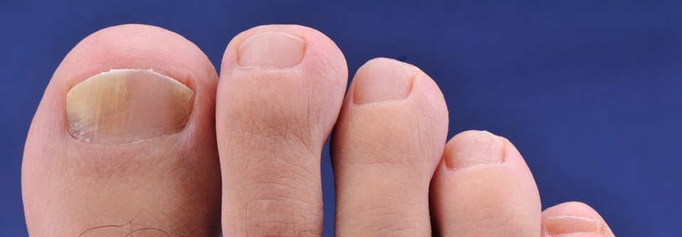 Dermatologie: Leitlinie Nagelpilz Am häufigsten wird Nagelpilz hierzulande von Dermatophyten hervorgerufen.