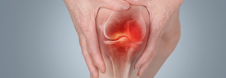 Gonarthrose: Kein Effekt durch Hyaluronsäure Die Rate der Nebenwirkungen durch die Hyaluronsäure-Injektion war um rund 50 % erhöht.