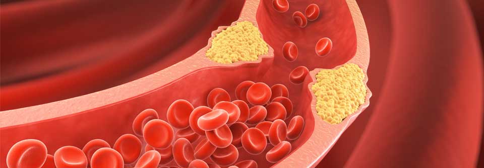 Cholesterin: Pflanzenkraft gegen Cholesterin Für Cholesterinwerte im Grenzbereich gib es ein pflanzliches Nahrungsergänzungsmittel.