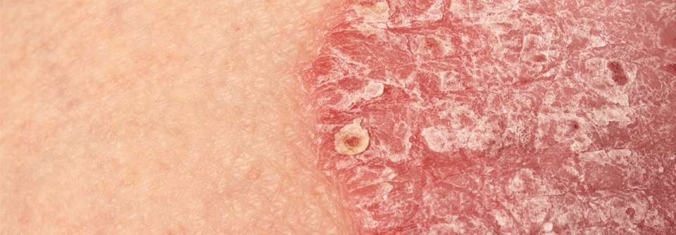 Die Belastungen im Leben von Menschen mit einer Plaquepsoriasis kumulieren rasch nach Ausbruch der Erkrankung.