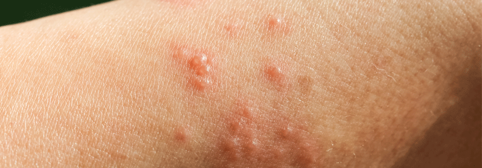 Positive Daten beim bullösen Pemphigoid auf dem AAD-Jahreskongress vorgestellt BP ist eine chronische, stark beeinträchtigende, rezidivierende Hauterkrankung mit zugrundeliegender Typ-2-Inflammation, die durch starken Pruritus und Blasenbildung, Hautrötungen sowie schmerzhafte Läsionen gekennzeichnet ist.