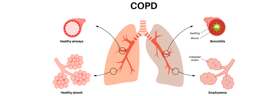 COPD: Therapie ist verbesserungswürdig An der chronischen Lungenerkrankung COPD leidet jeder zehnte Bundesbürger über 40 Jahren.