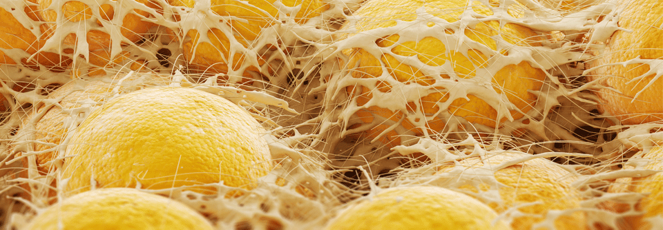 Lipodystrophie: Wenn Immuncheckpoint-Inhibitoren das Fettgewebe zum Schmelzen bringen Fettgewebe, das plötzlich verschwindet – ausgelöst durch Immuncheckpoint-Inhibitoren.