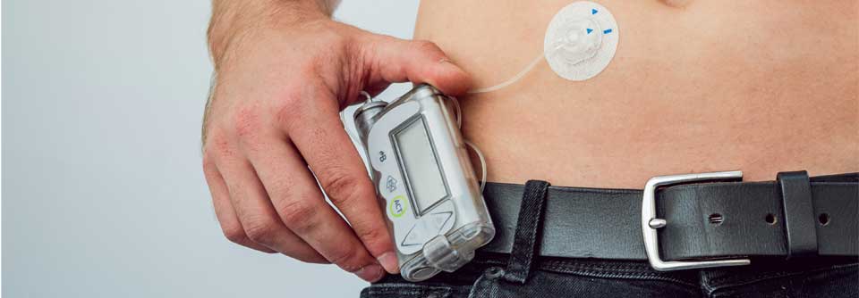 Diabetes: Insulinpumpen zeigen positive Wirkung Die Lebensqualität der Betroffenen steigt erheblich.