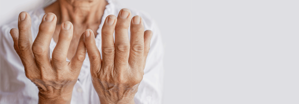 Psoriasisarthritis belastet Psyche stärker als rheuamtoide Arthritis Sowohl die rheumatoide Arthritis als auch die Psoriasisarthritis haben einen großen Einfluss auf die Lebensqualität der betroffenen Menschen.