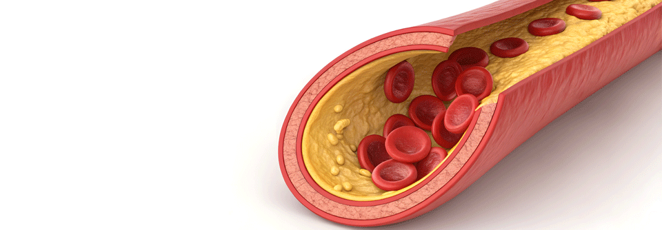 Cholesterin: Zu viel HDL ist auch nicht gut HDL-Cholesterin wird meist als „gutes“ Cholesterin bezeichnet