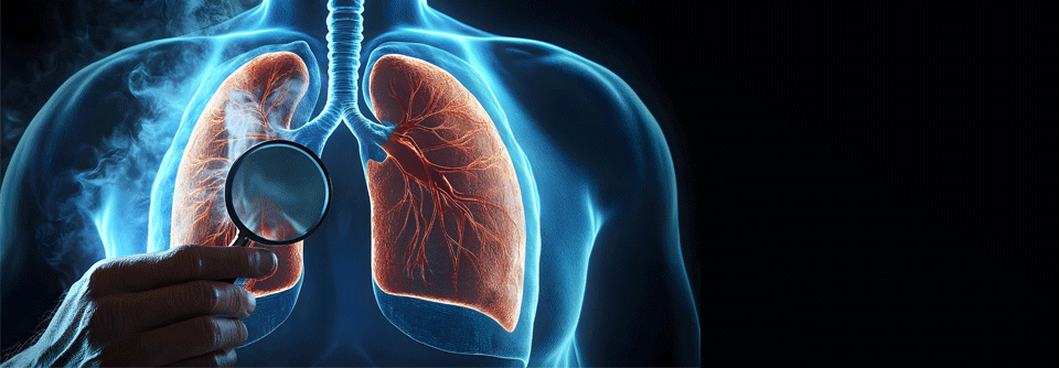 Neutrophile in Schach halten: Neue Aspekte für die Bronchiektasentherapie Noch gibt es kein Medikament, das speziell für die Behandlung von Bronchiektasen zugelassen ist.