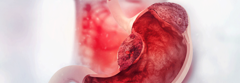 Durvalumab plus FLOT als neuer perioperativer Standard beim Magenkarzinom Eine zusätzliche perioperative Immuntherapie verlängerte das ereignisfreie Überleben.