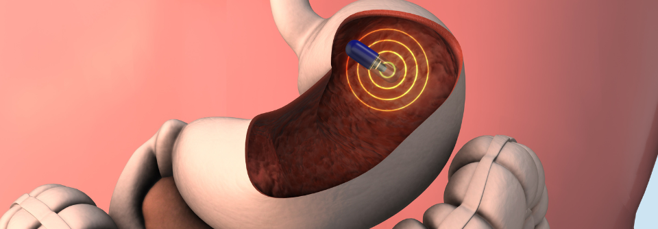 Bei auffälligem Stuhltest besser gleich eine klassische Koloskopie durchführen Die Kapselendoskopie gilt als minimalinvasive Alternative zur herkömmlichen Koloskopie. Trotzdem sollte man ihr nicht unbedingt den Vortritt lassen.