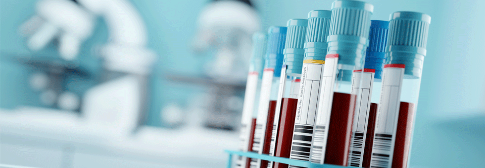 Lipoprotein(a) erhöht? Moderne Therapien senken den Spiegel um bis zu 99 % Menschen mit hohen Lipoprotein(a)-Werten tragen ein höheres kardiovaskuläres Risiko.
