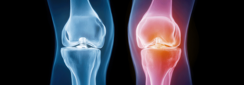 Knie-Operationen: Immer mehr Jüngere erhalten künstliche Kniegelenke Zwischen 2013 und 2016 ist die Zahl der Eingriffe, bei denen ein künstliches Kniegelenk eingesetzt wurde, von 143.000 auf 169.000 gestiegen.
