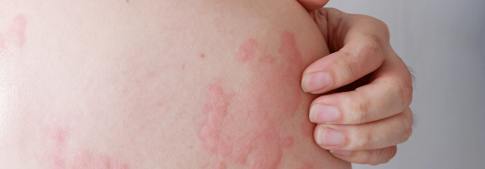 Darmkrebs: Schmieren gegen Hautausschläge Ein topischer BRAF-Inhibitor lindert EGFR-bedingte Hauttoxizität und unterstützt den Erhalt der Therapieintensität.