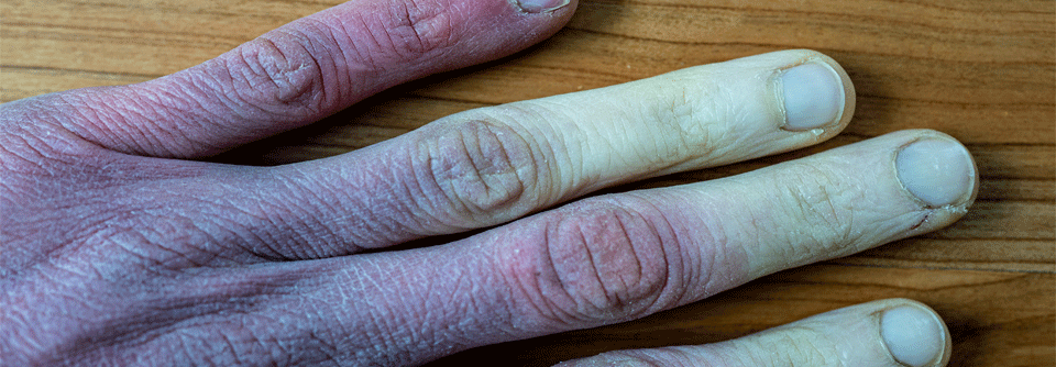 Neues zu den Auslösern und der Therapie beim Raynaud-Syndrom Ausgelöst wird das Raynaud-Phänomen ganz überwiegend durch Kälte – das ist bekannt.