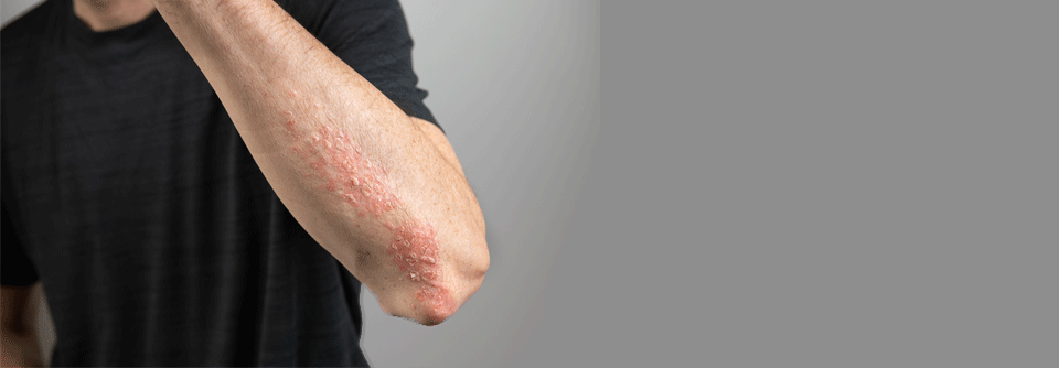 PsA mit Risiko: Frühstart mit TNFi wirkt besser Zur Behandlung der Psoriasisarthritis (PsA) empfehlen die Leitlinien einen T2T-Ansatz