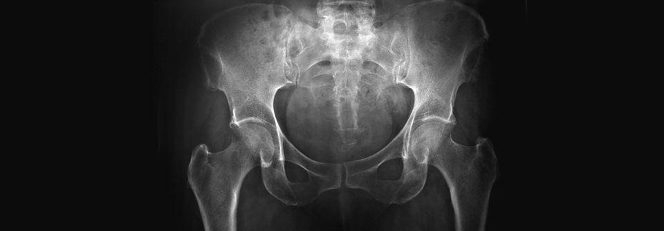 Wie bei DISH das Knochenwachstum zur Gefahr wird Die diffuse idiopathische Skeletthyperostose fällt oft als Zufallsbefund beim Röntgen auf.
