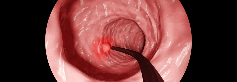 Die Darmspiegelung hat in Deutschland in den Jahren 2008 bis 2011 vermutlich mehr als 25.000 Darmkrebs-Todesfälle verhindert.