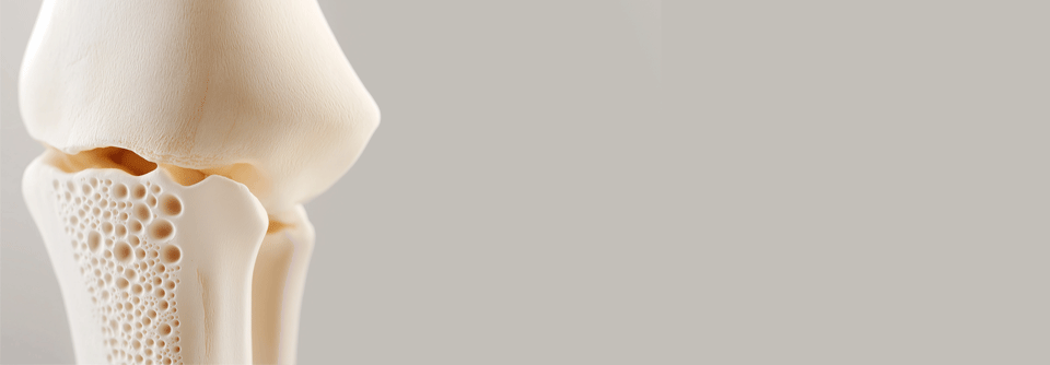 Nach Absetzen des Osteoporose-Wirkstoffs Denosumab (Prolia®) kann es zu einem Knochendichteverlust kommen, der das Risiko für Frakturen erhöht.