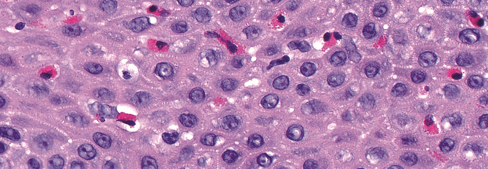 Neue Behandlungsansätze für die eosinophile Ösophagitis Im vergangenen Jahr ist intensiv an Therapieoptionen für die eosinophile Ösophagitis geforscht worden.
