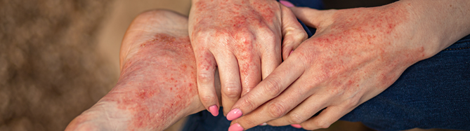 Neuer JAK1-Inhibitor als orale Alternative zu Biologika? Ivarmacitinib bietet wohl zukünftig eine neue orale Behandlungsoption bei atopischer Dermatitis.