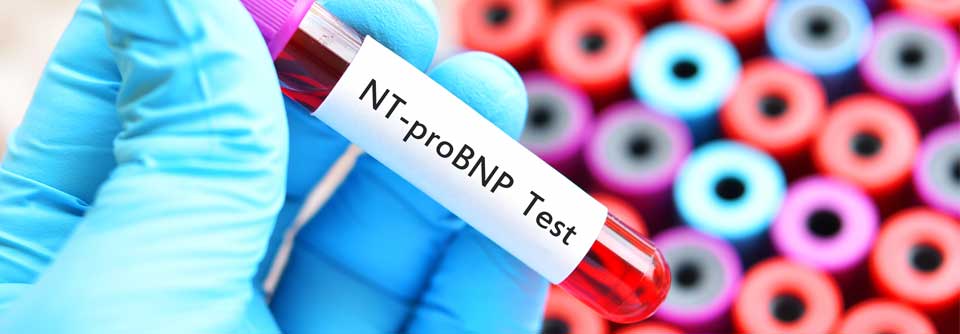 Nt-proBNP scheint der stärkste Biomarker für das Auftreten von Vorhofflimmern zu sein. 