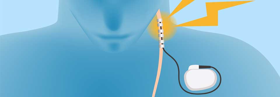 Depression: Vagusnerv-Stimulation kann helfen Mit einer elektrischen Stimulation des Vagusnervs wurde eine Remission nach 49 Monaten erreicht.