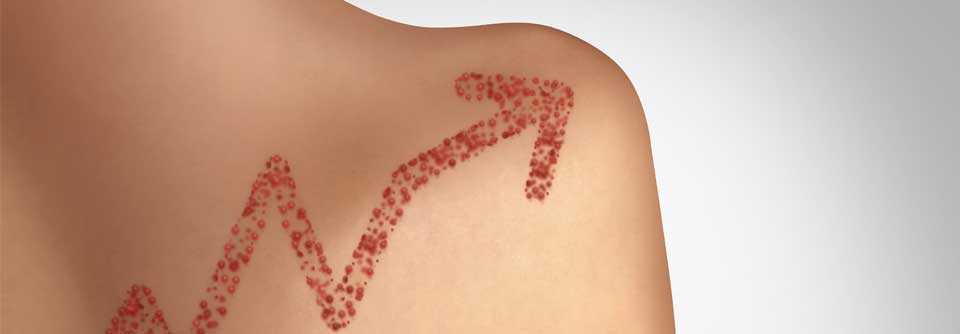 Betroffen sind überwiegend ungeimpfte Kinder, aber auch nicht oder unzureichend geimpfte Jugendliche und Erwachsene.