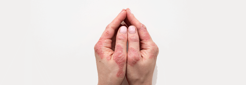 Psoriasisarthritis beginnt oft vor der Haut Oft leiden Betroffene schon vor Auftreten der Hauterkrankung an arthritischen Symptomen